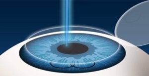 lasik-chirurgie-refractive